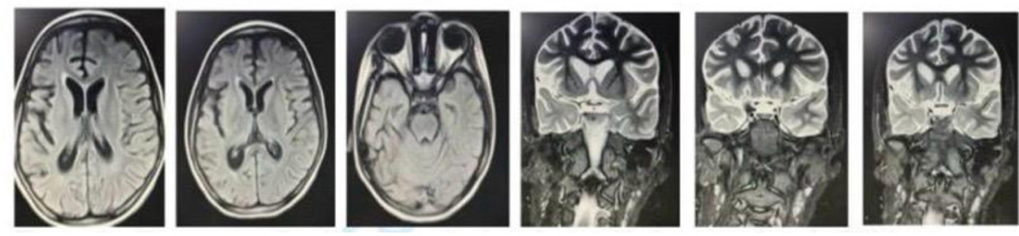 Figura 1. Ressonância magnética (RM) de encéfalo pré-operatória, sequências ponderadas em T2/FLAIR, demonstrando atrofia do hemisfério direito com redução de volume e alteração de sinal no hipocampo direito, sugestiva de esclerose mesial temporal.