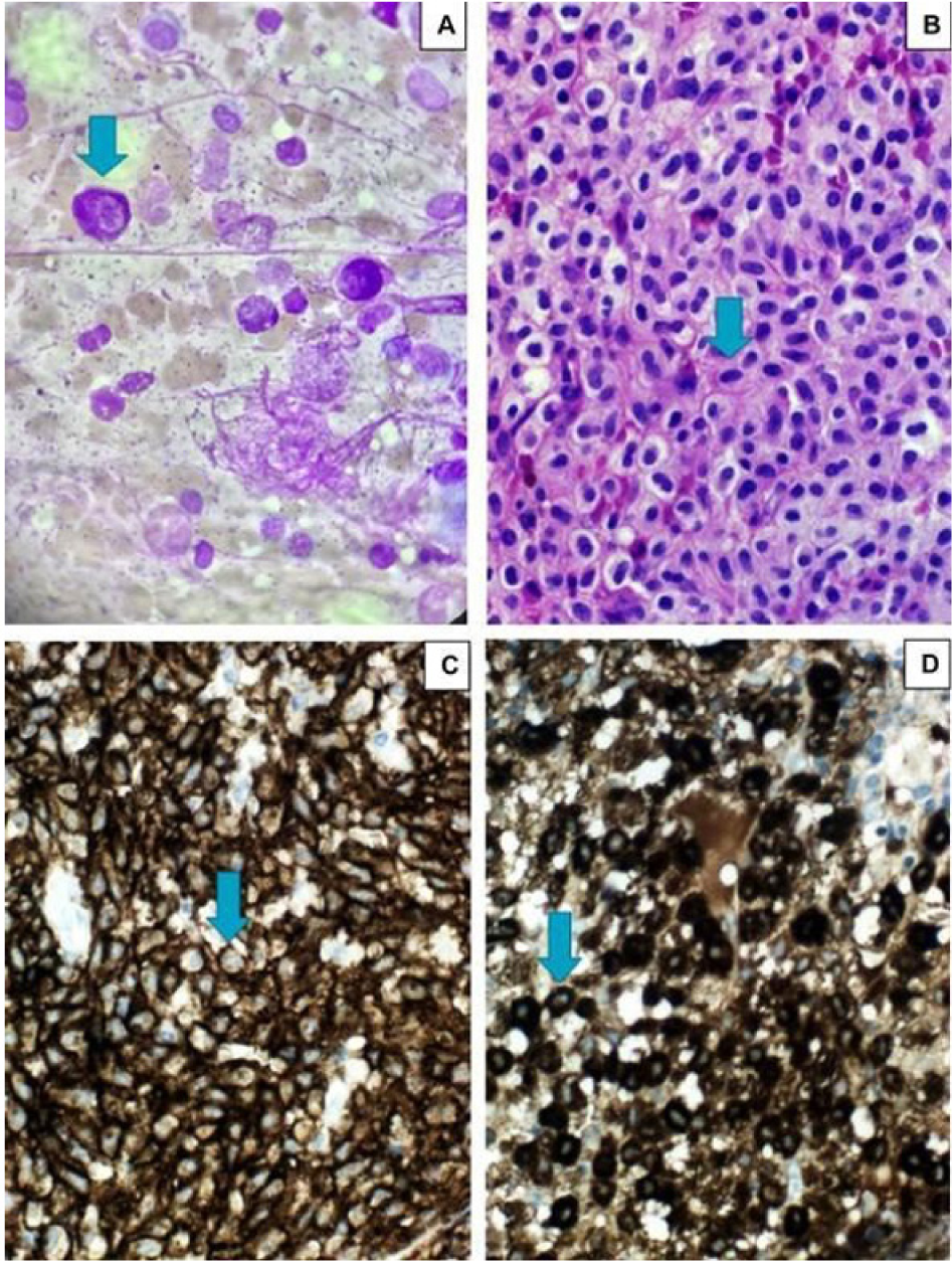 Figura 1. A: Aspirado de medula óssea (MO) - células ovoides com núcleo centralizado e presença de grânulos citoplasmáticos; B: Biópsia de MO – denso agregado mononuclear de células ovoides com citoplasma eosinofílico sugerindo infiltrado de mastócitos; C e D: Imuno-histoquímica de biópsia de MO com marcadores positivos para c-KIT e triptase respectivamente.